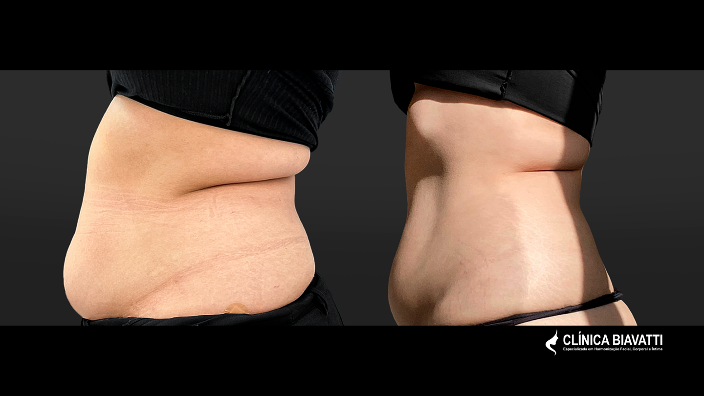 Dra. Débora Biavatti - CRF 25255 Protocolo_ Lipozic - Perda de 11,5kg em 9 semanas