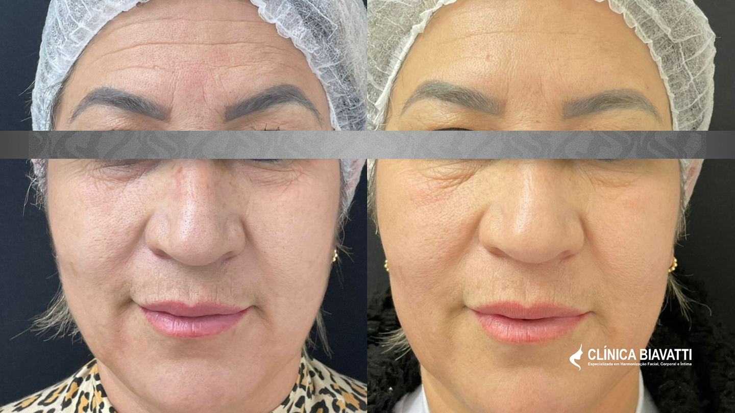 Por Dra. Anelise Vieira - CRF 25416 LineSkin NANOLIFT