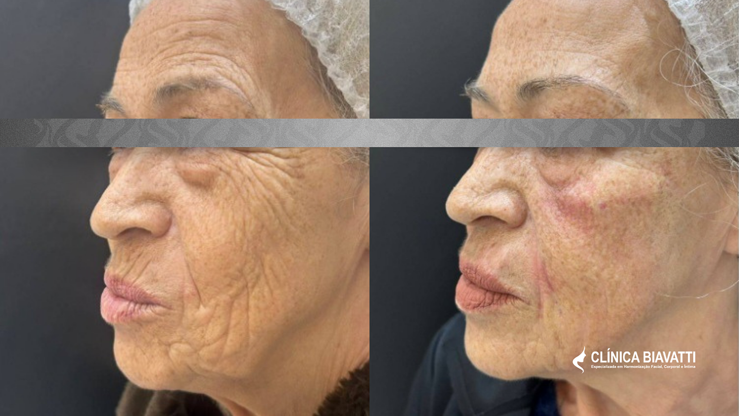 Por Dra. Daniela Bonotto - CRBM 5 6071 Harmonização e Rejuvenescimento Facial