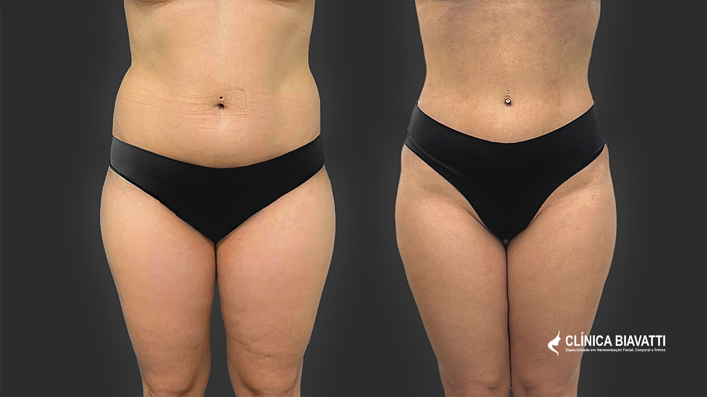Por Dra. Débora Biavatti - CRF 25255 Protocolo Lipozic - Perda de 8kg em 7 meses