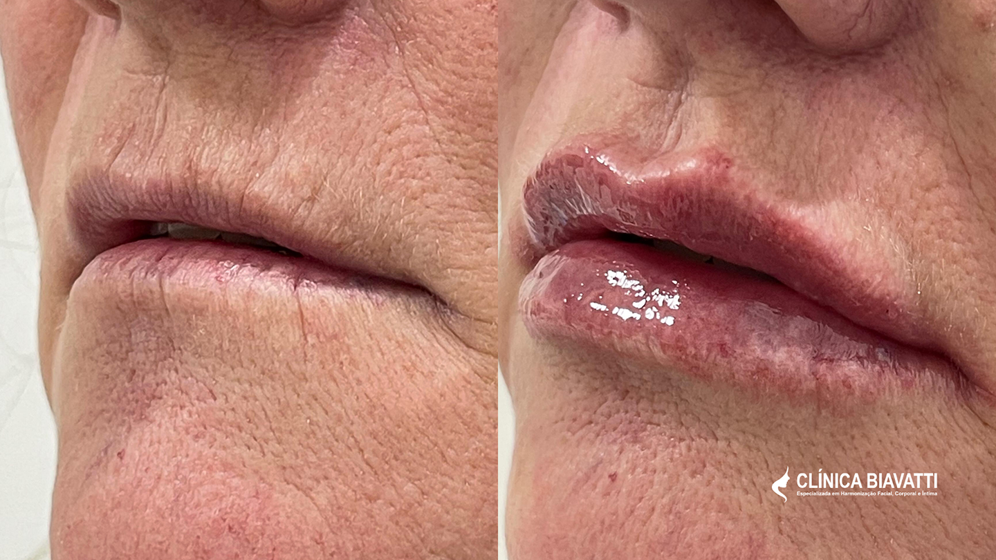 Por_ Dr. Rui Vitor Cotrim - CRBM 6 5691 Protocolo_ Preenchimento Labial