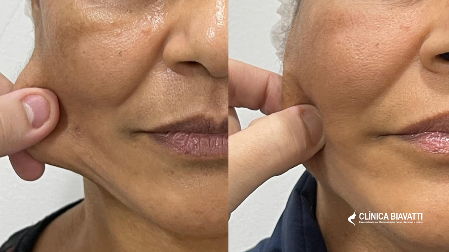 Por_ Dr. Rui Vitor Cotrim - CRBM 6 5691 Skinbooster + Sculptra