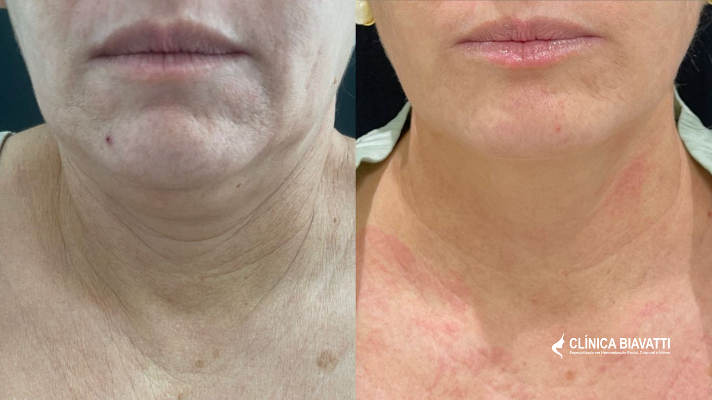 Por_ Dra. Camila Bithencourt - CRBM 5 4431 Laser Lumière + Bioestimulados de Colágeno + Skinbooster