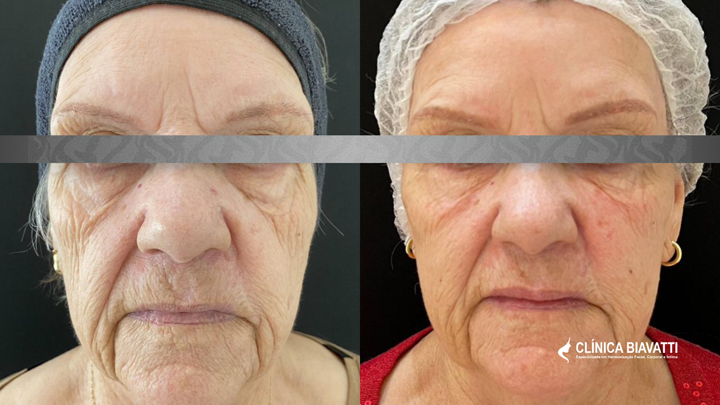 Por_ Dra. Débora Biavatti - CRF 25255 Estética Regenerativa_ Skinbooster + Elleva